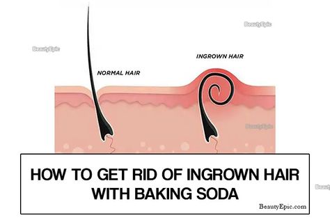 Ingrowing Hair, Ingrown Hair Remedies, Lip Hair Removal, Baking Soda For Hair, Chin Hair, Ingrown Hair Removal, Pimples Under The Skin, Home Remedies For Hair, Facial Hair Removal