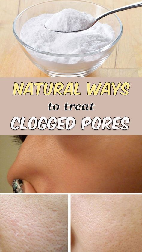 5 natural ways to treat clogged pores | by Moudnibemouaad | Medium Pores Remedies, Clean Nose Pores, Get Rid Of Clogged Pores, Brown Spots On Skin, Spots On Skin, Nose Pores, Open Pores, Skincare Acne, Brown Spots On Face