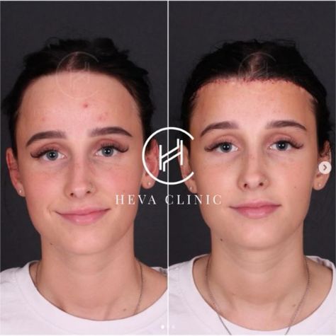 Female Forehead Reduction Before & After Results at Heva Clinic, Turkey Forehead Reduction Surgery, Forehead Reduction, Hair Transplant Women, Reduction Surgery, Medical Consultation, Free Medical, Hair Transplant, Surgery, The Face