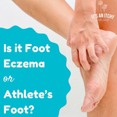 foot eczema - main Oils For Sinus Infection, Zoloft Withdrawal, Appraisal Form, Oils For Congestion, Natural Constipation Remedies, Oils For Sinus, Healthy Legs, Acne Medication, Allergy Asthma