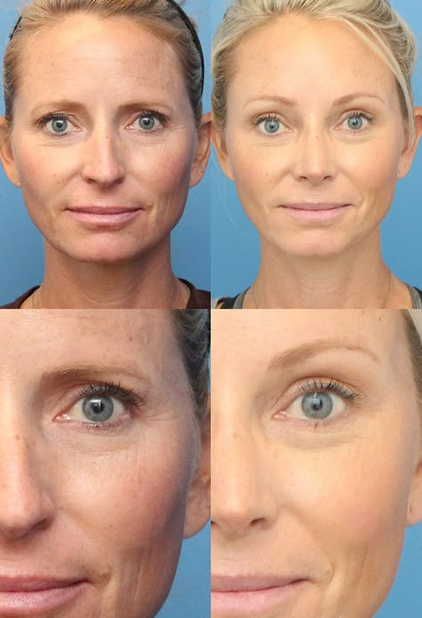 Temporal Brow Lift, Endoscopic Brow Lift Before And After, Eye Brow Lift Before And After, Eyebrow Lift Before And After, Botox Eyebrow Lift Before And After, Brow Lift Botox Eyebrows, Upper Blephoraplasty Before And After, Brow Lift Before And After, Eyebrow Lift Botox Before And After