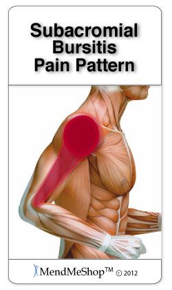 Trigger Points Shoulder Shoulder Bursitis, Subacromial Bursitis, Bursitis Shoulder, Rotator Cuff Exercises, Shoulder Pain Exercises, Bursitis Hip, Shoulder Rehab, Shoulder Impingement, Shoulder Pain Relief