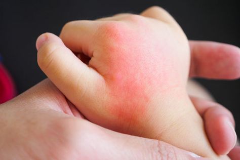 We all know children with food allergies. They have become much more prevalent in the last 20 years and have increased by 50%. Experts say that while millions of children suffer from these allergies, they are not born with them as babies. In fact, the allergies develop as a child grows. The most common, and […] The post How Eczema Can Potentially Lead To Food Allergies In Children appeared first on Scary Mommy. Home Remedies For Allergies, Kids Allergies, Home Remedies For Skin, Allergic Rhinitis, Allergy Remedies, Allergy Asthma, Skin Allergies, Itchy Skin, Food Allergies