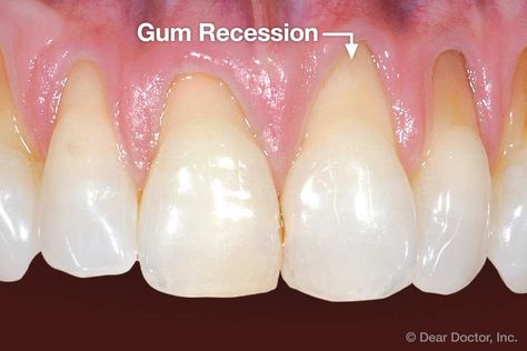 Gum recession. Teeth Pain Relief, Wisdom Teeth Pain Relief, Dental Bridge Cost, Wisdom Teeth Pain, Dental Aesthetics, Teeth Art, Gum Recession, Reflux Diet, Dental Anatomy