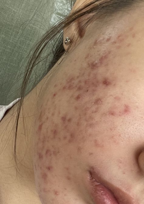 Acne Girls Pretty, Bad Acne Pictures, Acne Wallpaper, Beauty Marks On Face, Girls With Acne, Acne Pretty, Strawberry Freckles, Acne Girl, Acne Aesthetic