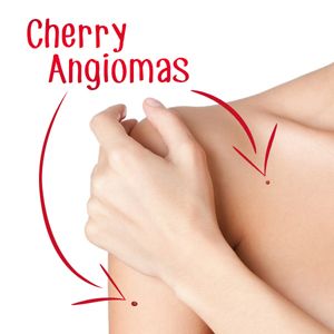 Cherry Angioma Removal, Red Skin Spots, Mole Meaning, Red Freckles, Red Moles, Remove Skin Tags Naturally, Skin Moles, Mole Removal, Skin Spots