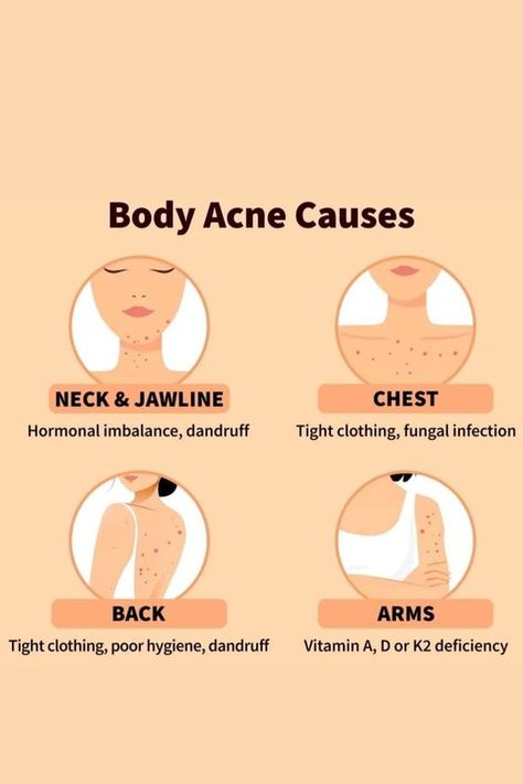 body acne causes, acne Blind Pimple, Bad Acne, Skin Advice, Acne Skincare, Natural Face Skin Care, Natural Acne Remedies, Types Of Acne, Acne Causes, Body Acne