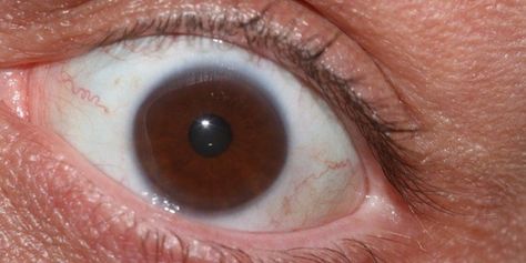 What Causes Bulging Eyes Bulging Eyes, Graves Disease, Comb Over, Old Lady, Natural Supplements, Autoimmune Disease, Comb, Muscles, Disease