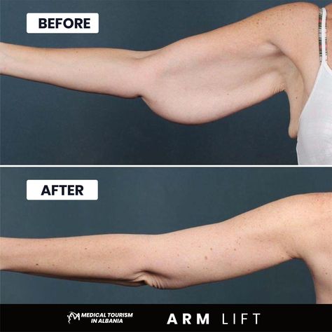 After years of feeling self-conscious about the shape of her arms, our patient took the empowering step to undergo an arm lift with us. The outcome? Sculpted arms that restored her confidence, allowing her to move with grace and assurance. 💪✨ Every time she raises her arms now, it's with a renewed sense of pride and joy, testament to the skills of our team and her own commitment to embrace transformation. 🌟🤗 #ArmLiftJourney #SculptedConfidence #RediscoveredGrace I Am Disciplined, Arm Lift, Sculpted Arms, Beauty Self Care, Mommy Makeover, Medical Tourism, Self Conscious, Plastic Surgery, The Shape