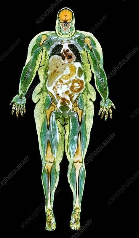 Obese woman, MRI scan - Stock Image - C007/2246 - Science Photo Library Mri Brain, Brain Images, Brain Scan, Internal Organs, Mri Scan, Magnetic Resonance Imaging, Heart And Lungs, Magnetic Resonance, Body Scanning