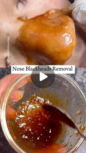 Baking Soda And Apple Cider Vinegar Face Mask, Face Mask That Pulls Out Blackheads, How To Make Face Mask For Blackheads, Face Pack For Blackheads, What Helps Get Rid Of Blackheads, How To Make Skin Poreless, How To Remove Nose Pores, Blackheads Mask Diy, Easy Way To Remove Blackheads