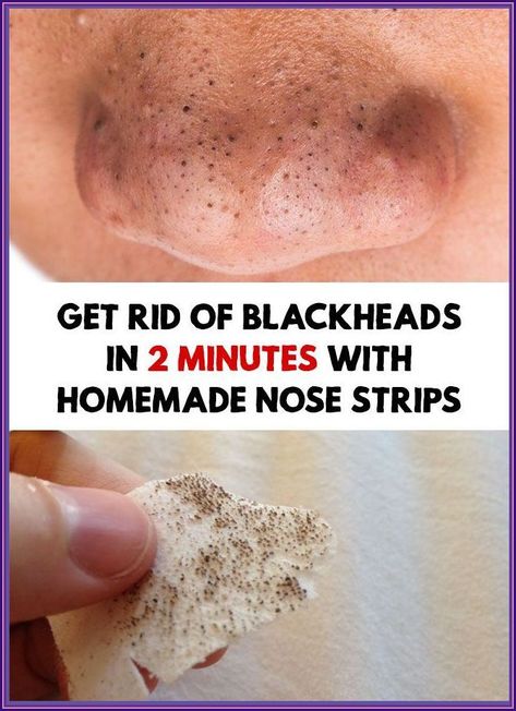 Get Rid of Blackheads For Good Remove Blackheads From Nose, Nail Growth Tips, Maquillage Yeux Cut Crease, Blackheads On Nose, Pore Strips, Rid Of Blackheads, Nose Strips, Remove Blackheads, Get Rid Of Blackheads