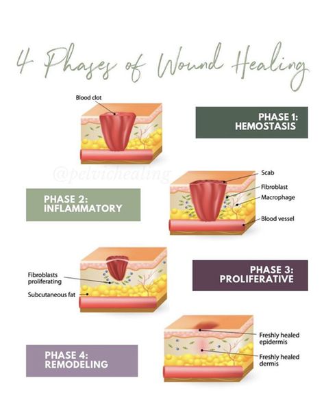 4 Stages of Wound Healing | physical therapy Stages Of Wound Healing, Wound Healing Stages, Wound Healing Nursing, Ostomy Nursing, Wound Nurse, Wound Care Nurse, Stages Of Healing, Rectus Abdominis Muscle, Wound Care Nursing