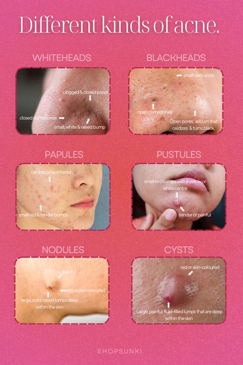 Unlock the secrets of your skin with "Understanding Acne Types: What Your Pimples Reveal About Your Skin and Style." Discover the meanings behind where pimples are located, from papules to nodular acne. Explore essential skincare facts and high school outfit tips for oily skin. Visit our skincare shop for expert advice and products tailored for you.   #Skincare #AcneTypes #BeautyTips #OilySkin #Fashion Where Pimples Are And What They Mean, Papules Acne, Nodule Acne, What Causes Pimples, Acne Inversa, Nodular Acne, Affordable Skin Care Products, Skincare Shop, How To Reduce Pimples