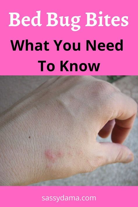 Bed bug bites can be very itchy, annoying, and embarrassing! Here are ways you can identify, prevent, and control bed bugs in your home. Bed Bug Bites Remedies, Bed Bug Bites Pictures, Bed Bugs Essential Oils, Bed Bug Remedies, Bedbugs Removal, Bug Bites Remedies, Get Rid Of Bed Bugs, Bed Bug Spray, Bug Infestation