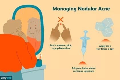 Nodule Acne, Skin Treatments For Acne, Anti Acne Skin Care, Nodular Acne, Inflamed Pimple, Treatments For Acne, Back Acne Remedies, Blind Pimple, How To Help Nausea