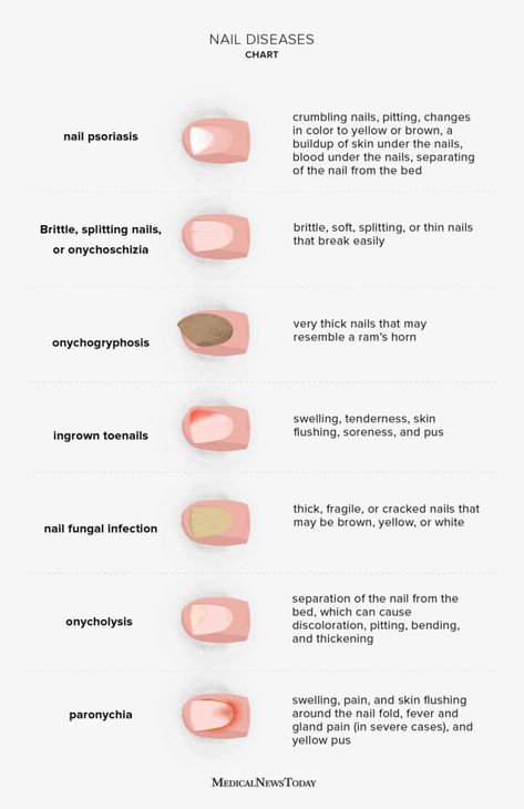 Nail diseases chart: Pictures, symptoms, and treatments Nail Disorders, Nail Tech School, Nail Conditions, Health Chart, Nail Problems, Nail Infection, Holistic Diet, Tongue Health, Brown Spots On Face