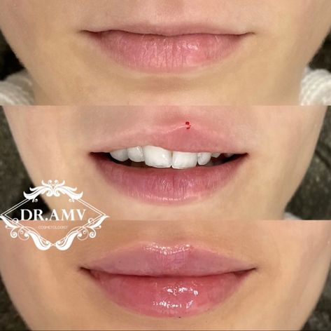 Lip Filler For Uneven Lips, One Syringe Lip Filler, Lip Filler Small Mouth, Lip Filler Inspiration Small Lips, Natural Lip Fillers 0.5ml, Lip Filler On Small Lips, Armonizacion Facial, Before And After, Natural Lip Fillers