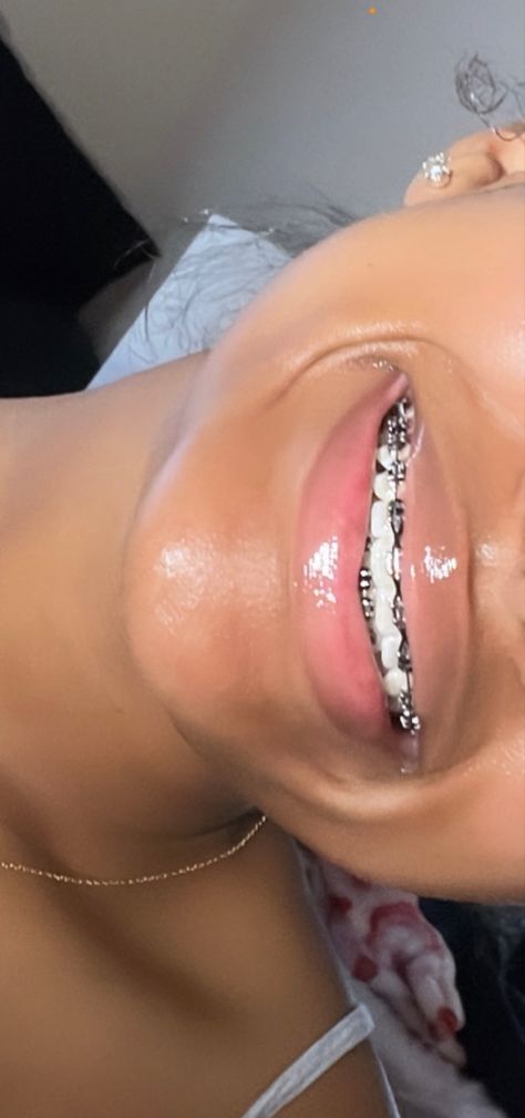 Pretty Teeth With Braces, Briblixks Pics, Braces And Lipgloss, Braces For Black Women, Braces Colors Light Skin, Braces Aesthetic Girl Black, Pink Braces Black Women, Braces Manifestation, Braces Colour Ideas