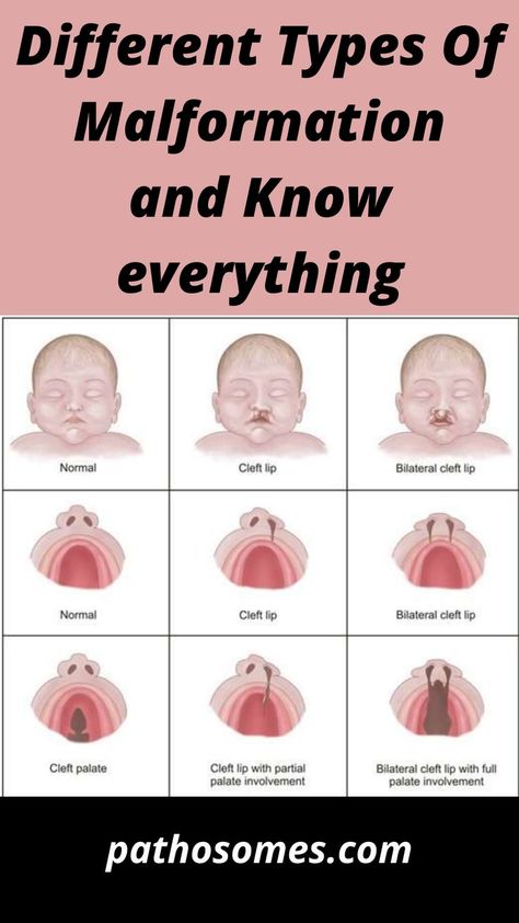 Different Types of malformation Praxis Study, Maxillofacial Surgery, Cleft Lip And Palate, Cleft Palate, Cleft Lip, Mother Baby Nurse, Spina Bifida, Congenital Heart Defect, Heart Defect