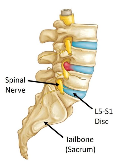 Treating an L5-S1 Disc Herniation: A Case Study - Regenexx L5 S1, Tooth Nerve, Disc Herniation, Back Spasm, Gross Things, Bulging Disc, Disk Herniation, Spinal Nerve, Nerve Pain Relief