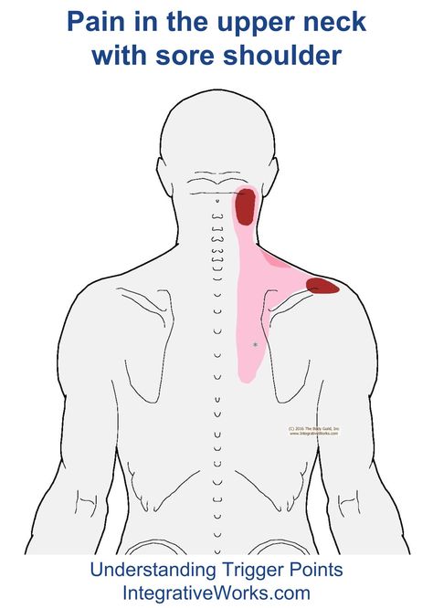 Understanding Trigger Points - Neck Pain with Sore Shoulder Shoulder Trigger Points, Trigger Points Neck, Shoulder Muscle Pain, Forward Head Posture Exercises, Sore Shoulder, Sore Neck, Neck Muscles, Trigger Point Therapy, Back Pain Remedies