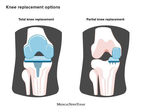 Parts Of The Knee, Partial Knee Replacement, Anterior Cruciate Ligament, Rehabilitation Exercises, Cruciate Ligament, Bone Fracture, Knee Replacement Surgery, Knee Surgery, Knee Replacement