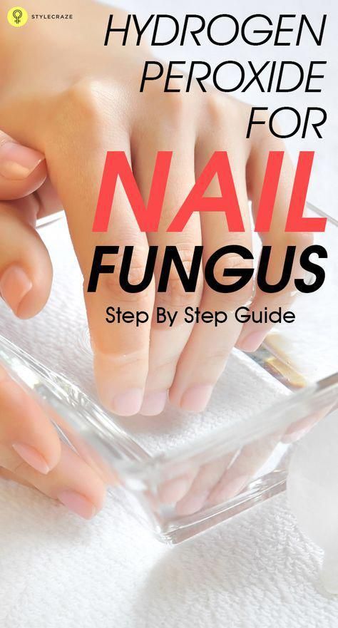 Nail Fungus Remedy, Nail Infection, Fungal Nail, Ingrown Toe Nail, Toenail Fungus, Fitness Magazine, Nail Fungus, Hydrogen Peroxide, Nail Health