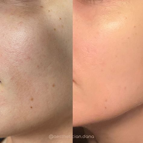 Mesotherapy Before And After, Hyperpigmentation Before And After, Skin Before After, Skin Before And After, Dysport Before And After, Microneedling Before And After, Before After Skincare, Skinpen Microneedling, Before And After Acne