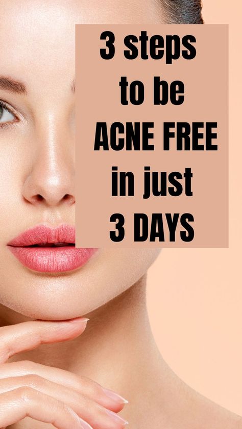 steps to be acne free in just 3 days Best Way To Clear Acne Fast, How To Get Clear Acne Free Skin, How To Clear Acne In A Week, Best Facial For Acne, How To Keep Your Face Acne Free, Glow Up Acne Tips, How Do I Get Rid Of Acne, How To Clean Acne, How To Get Rid Of Acne In A Day