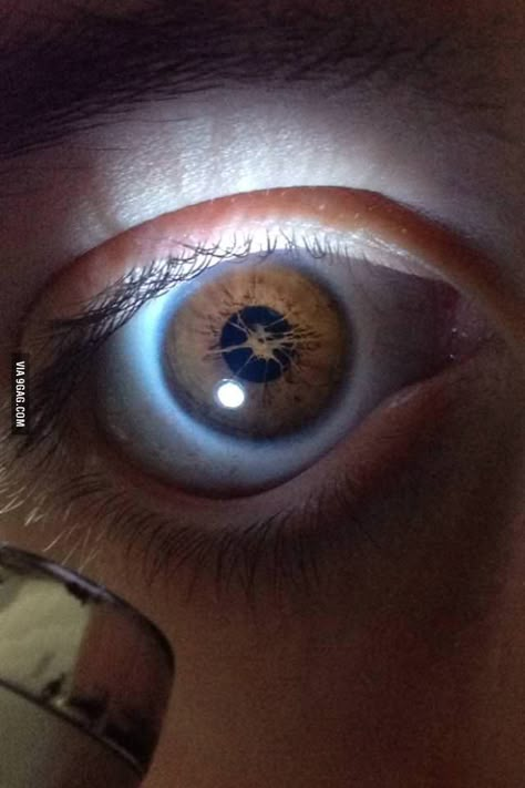 My friend's eye. I can't remember what he said causes it to be like this Broken Iris Eye, Eye Looking Up, Eyes Looking Up, Faded Eyes, Broken Iris, Lifeless Eyes, Rare Eye Colors, Different Eyes, Iris Eye