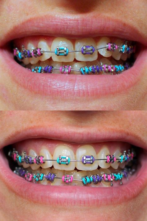 Best Color For Braces, Color For Braces, Rainbow Braces, Braces Girl, Braces Colors Combinations, Invisible Teeth Braces, Natural Teeth Whitening Diy, Cute Braces Colors, Kids Braces