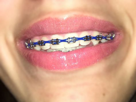 Blue braces Dark Blue Power Chain Braces, Midnight Glow Braces, Royal Blue Power Chain Braces, Purple Power Chain Braces, Braces Royal Blue, Navy Blue Power Chain Braces, Maroon Braces Teeth, Royal Blue Braces Teeth, Navy Blue Braces Teeth