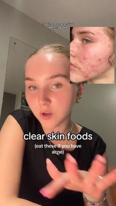 #BEAUTY, #RELATIONSHIPS #Fashion #Animals #Outfits #Winter Outfits #Animals Foods For Clear Skin, Skin Foods, Clear Skin Diet, Acne Diet, Acne Free Skin, Skin Diet, Serious Skin Care, Natural Acne Remedies, Clear Skin Tips