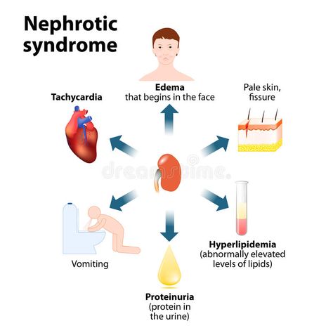 Image result for nephrotic syndrome Focal Segmental Glomerulosclerosis, Pediatric Nurse Practitioner, Nephrotic Syndrome, Low Estrogen Symptoms, Basic Anatomy And Physiology, Med School Motivation, Medical Student Study, Nursing School Notes, Medical School Essentials