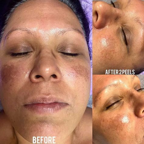 Face Peel Chemical, Vi Peel Before And After, Chemical Peel Before And After, Chemical Face Peel, Vi Peel, Chemical Burn, Chemical Peel At Home, Aesthetic Types, Acid Peel