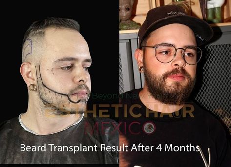 A huge number of people opt for hair transplants as a fix for their physical appearance but often neglect their beard. For a man, beard is the one of the most important physical facial features. In today’s era, thicker beard is considered manly and attractive. All global celebrities such as George Clooney, Idris Elba, Jason Momoa have helped bring thick beard in fashion. #beardtransplant #beradloss #beardtransplantmexico Beard Transplant, No Beard, Thick Beard, Man Beard, Physical Appearance, Idris Elba, Beard Growth, Hair Transplant, George Clooney