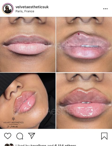 Lip Injections Black Women, Russian Pout Lips, Keyhole Pout Lip Filler, Lip Blushing Tattoo Before And After Black Women, Lip Injections Before And After Black Women, Russia Lip Filler, Lip Filler On Full Lips, Heavy Lower Lip Makeup, Types Of Lip Fillers