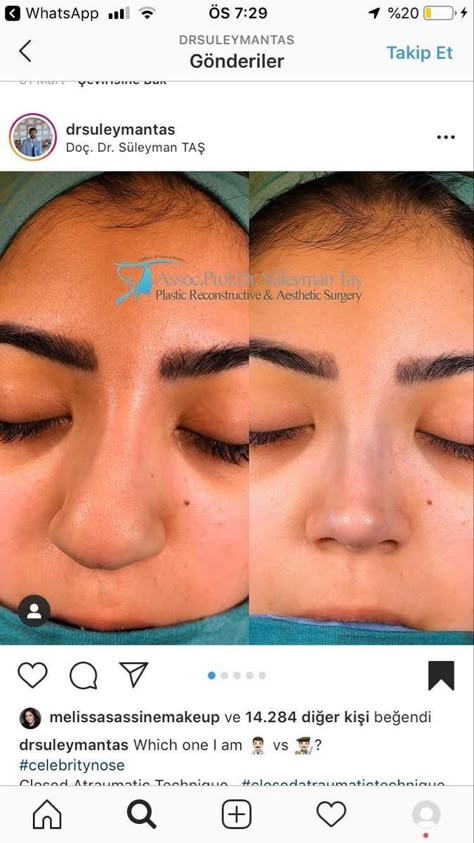 Nose Job Recovery, Nose Job Inspiration, Before And After Nose Job, Nose Plastic Surgery, Nose Surgery Rhinoplasty, Nose Job Inspo, Dream Nose, Bulbous Nose, Plastic Surgery Fail