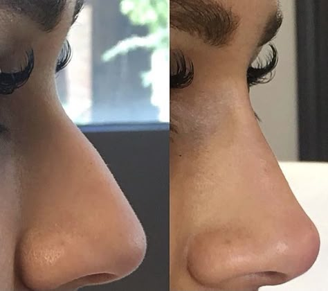 Nonsurgical Nose Job, Nose Plastic Surgery, Nose Surgery Rhinoplasty, Nose Job Inspo, Derma Fillers, Nose Fillers, Bulbous Nose, Rhinoplasty Nose Jobs, Rhinoplasty Before And After