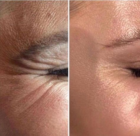 Crows Feet Botox Before After, Botox Before After, Skin Branding, Cosmetic Injections, Facial Injections, Crows Feet Wrinkles, Skin Highlighter, Botox Before And After, Botox Lips