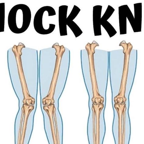 🦵🏻 Knee Pain | Joint Pain | Rehab on Instagram: "📢 Found this helpful? Save for later and SHARE with a friend⁠ ⁠ 🦵💥 Knock Knees⁠ .⁠ 🚨 Just 10 Minutes for All-Day Relief! 🚀 ⁠ .⁠ .⁠ 👉🏼 These exercises are effective if the knee issue is functional rather than structural.⁠ .⁠ This means that if knock knees (valgus position) are due to muscle weakness and tightness, these exercises can help. However, if it's a structural issue caused by bone or ligament alignment, strengthening may have limited impact.⁠ .⁠ 😄 The focus is on strengthening the hips to improve knee alignment. Give them a try and tag a friend who might benefit from these exercises.⁠ ⁠ 📷️ Credits: @dr.jcardozadpt , @ptvitals⁠ If the content OWNER (visual/audio) of this post wishes to have their content taken down, kindly Knock Knees, Hip Pain Relief, Knee Compression Sleeve, Breast Workout, Muscle Weakness, Knee Pain Relief, Chest Muscles, Knee Up, Leg Pain