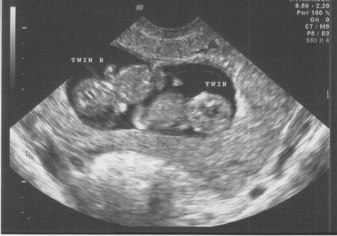 Twins Ultrasound, Twin Baby Boys, Baby Ultrasound, Ultrasound Pictures, Twin Pregnancy, Asian Babies, Foto Baby, Twin Boys