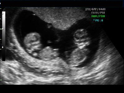 Miracles sonogram Twin Ultrasound, Twins Ultrasound, Baby Ultrasound Pictures, Dream Bored, Ultrasound Technician, Raising Twins, Baby Ultrasound, Pregnancy Apps, Having Twins