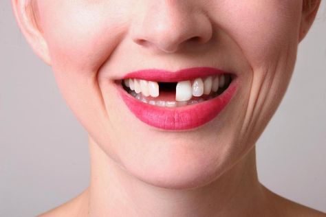 Tooth loss is linked to stress which can lead to more serious illness like heart disease Grow Back Receding Gums, Missing Tooth, Kedokteran Gigi, Partial Dentures, Dental Tourism, Tooth Replacement, Emergency Dentist, Missing Teeth, Teeth Implants