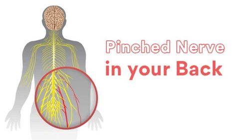 Discover the duration and relief options for pinched nerves – How long does a pinched nerve last and what you can do about it. - #Durationofatrappednerve #Durationofpinchednerverecovery #Howlongdoesacompressednervelast #Pinchednervehealingtime #Pinchednerverecoveryperiod #Pinchednervesymptomduration Nerves In Back, Nerve Conduction Study, Bulging Disc, Back Relief, Nerve Health, Pinched Nerve, Muscle Weakness, Nerve Damage, Good Posture