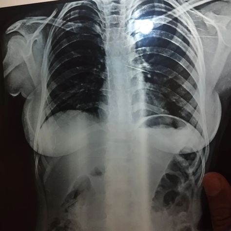 A 14 year old young girl accidentally inhaled foreign body (needle) while she was talking with friends. Came with complaints of cough and blood stained sputum, SOB on Deep Breathing. Parents are advised about the condition of the patients and further advised for Bronchoscopy from Nishtar Hospital Multan. Coughing Blood, Deep Breathing, Year Old, Stain, Parenting, With Friends, Film, Quick Saves