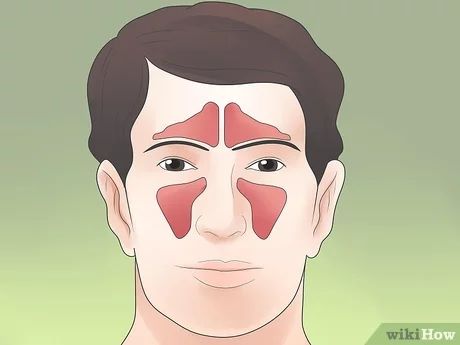 3 Ways to Stop Sinus Headaches - wikiHow Health Sinus Headache Remedies, Sinus Pressure Headache, Sinus Headache Relief, Blocked Sinuses, Getting Rid Of Headaches, How To Clear Sinuses, Sinus Infection Remedies, Headache Relief Instant, Sinus Pain