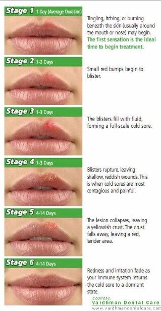 Cold sore stages Lip Sores, Cold Sore Remedy, Cold Sore Stages, Cold Sore Lip, Fever Blister, Cold Sores, Allergy Remedies, Canker Sore, Cold Sores Remedies