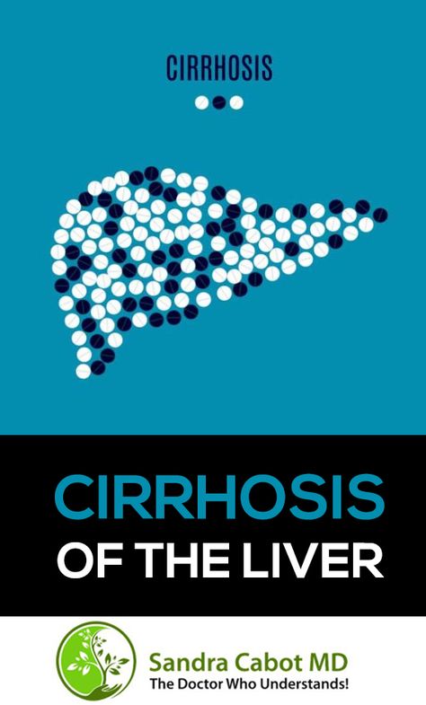 Cirrhosis of the liver is the term used to describe liver disease where chronic inflammation of liver cells has caused an extensive and widespread build up of scar tissue in the liver. Chirosis Of The Liver Diet, Food Good For Liver, Quadrants Of The Abdomen, Disease Quote, Liver Cleanse Juice, Liver Damage, Kidney Detox, Liver Diet, Feminine Health